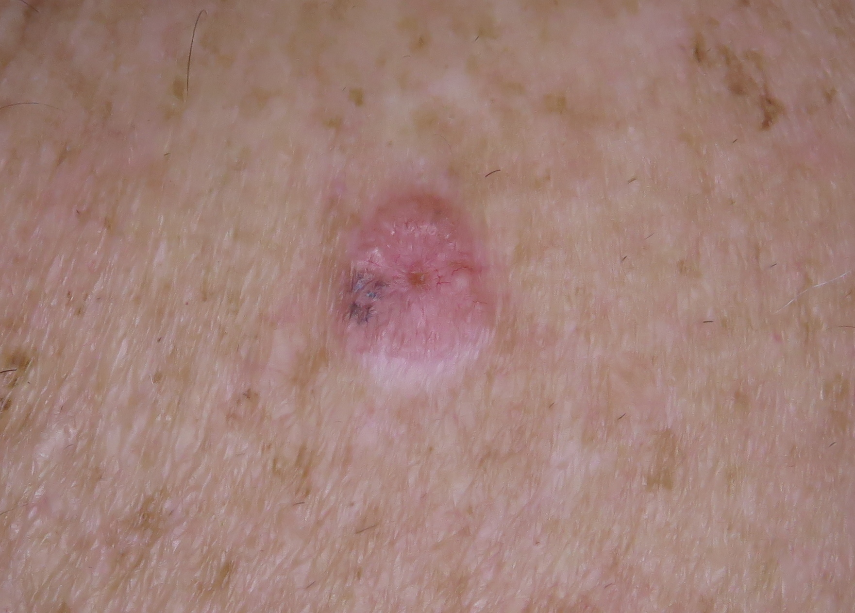 Summerland Skin Cancer Clinic » Basal Cell Carcinoma