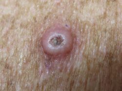 squamous carcinoma